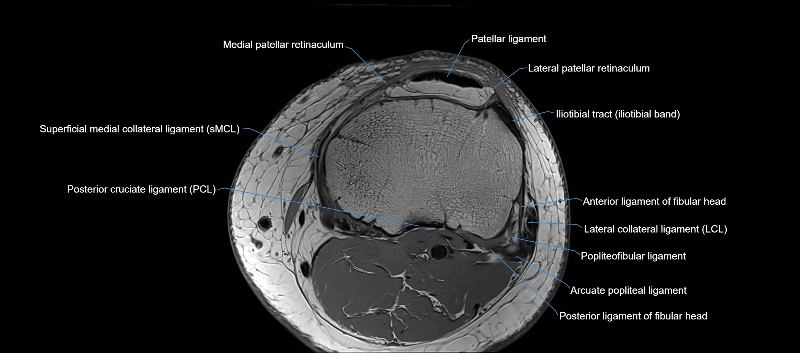 MRI Knee axial  ligaments cross sectional anatomy 3T  radiology  image-img-03001-00036.webp